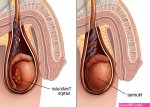 Testicular Cancer