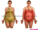 obesity